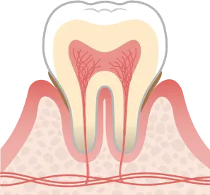 歯周炎（軽度）