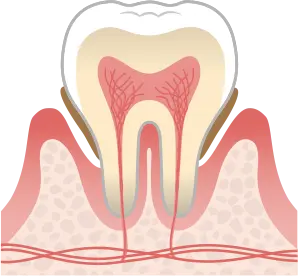 歯周炎（中度）