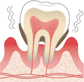 歯周炎（重度）
